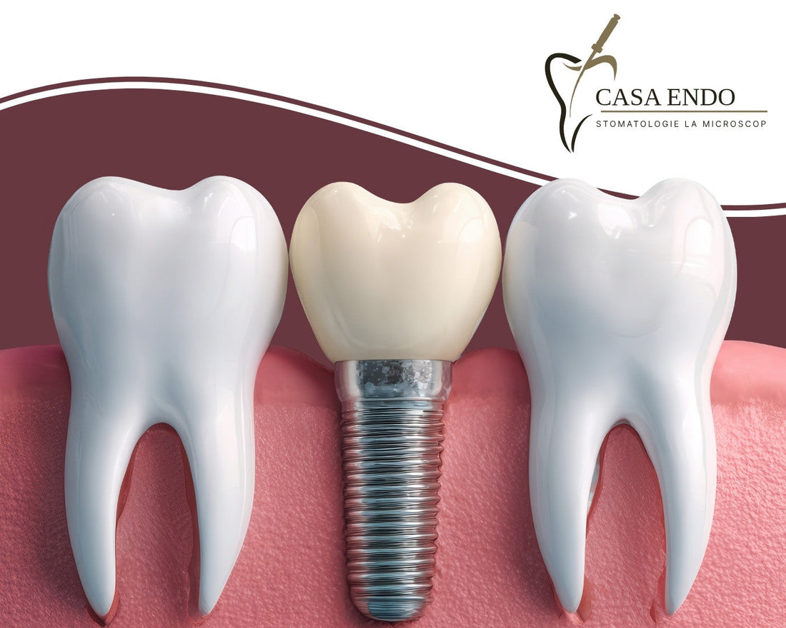 Implant dentar în Bacău: ce trebuie să știi înainte de tratament